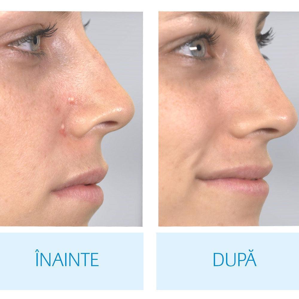 Aspirator Facial Derma Suction pentru Un Ten Curat și Luminos